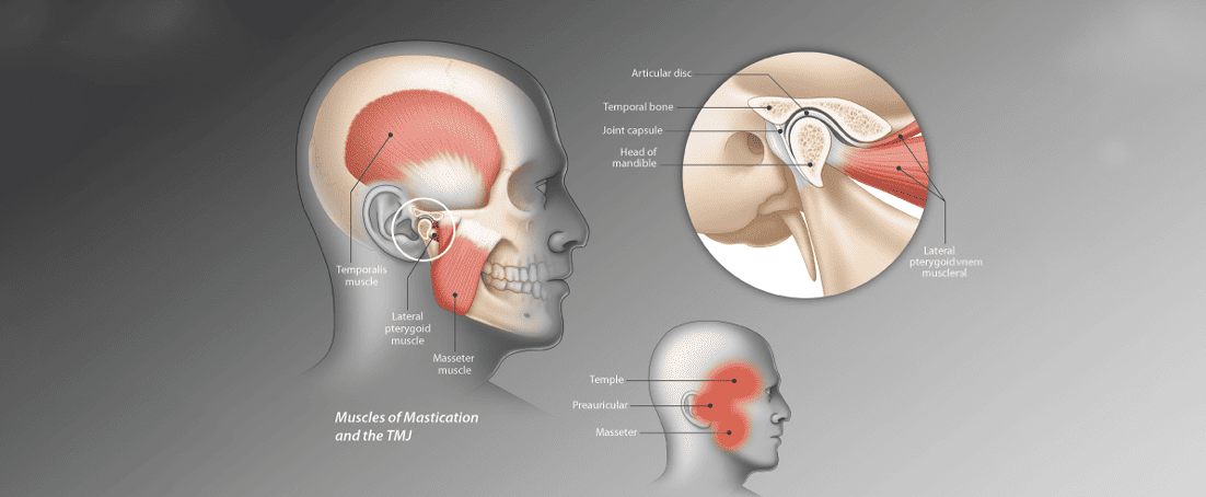 tmj mouth guard side effect