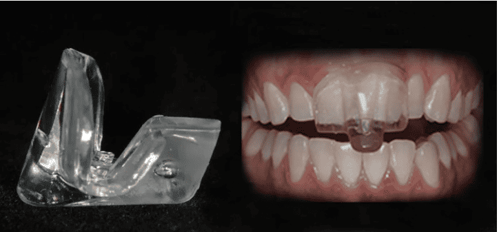 Occlusal Guards and Splints Comprehensive Guide - TeethCura